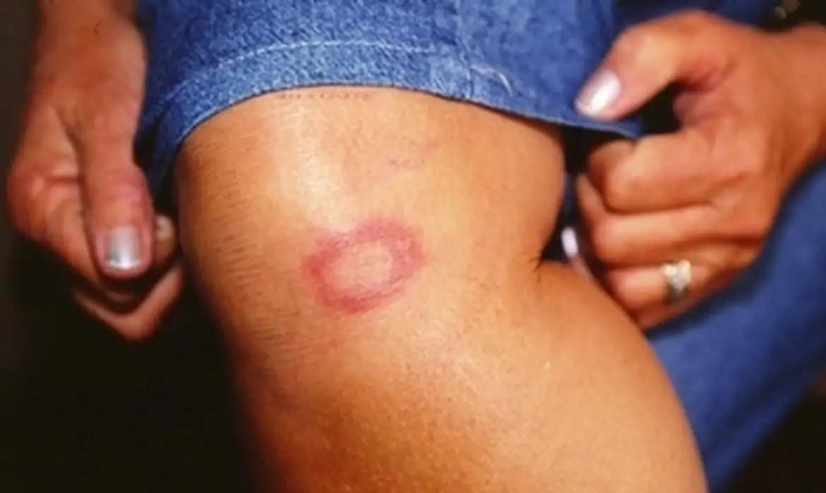 Ministério da Saúde lança campanha para conscientização sobre hanseníase