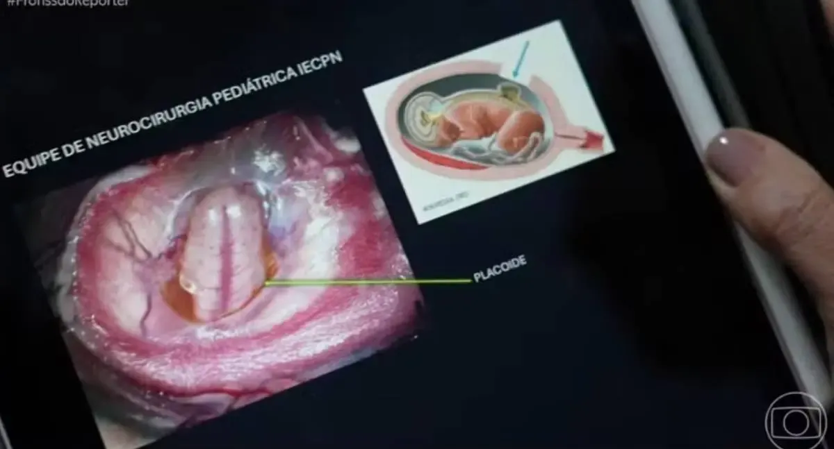 Cirurgia inédita do SUS corrige coluna de bebê antes do nascimento