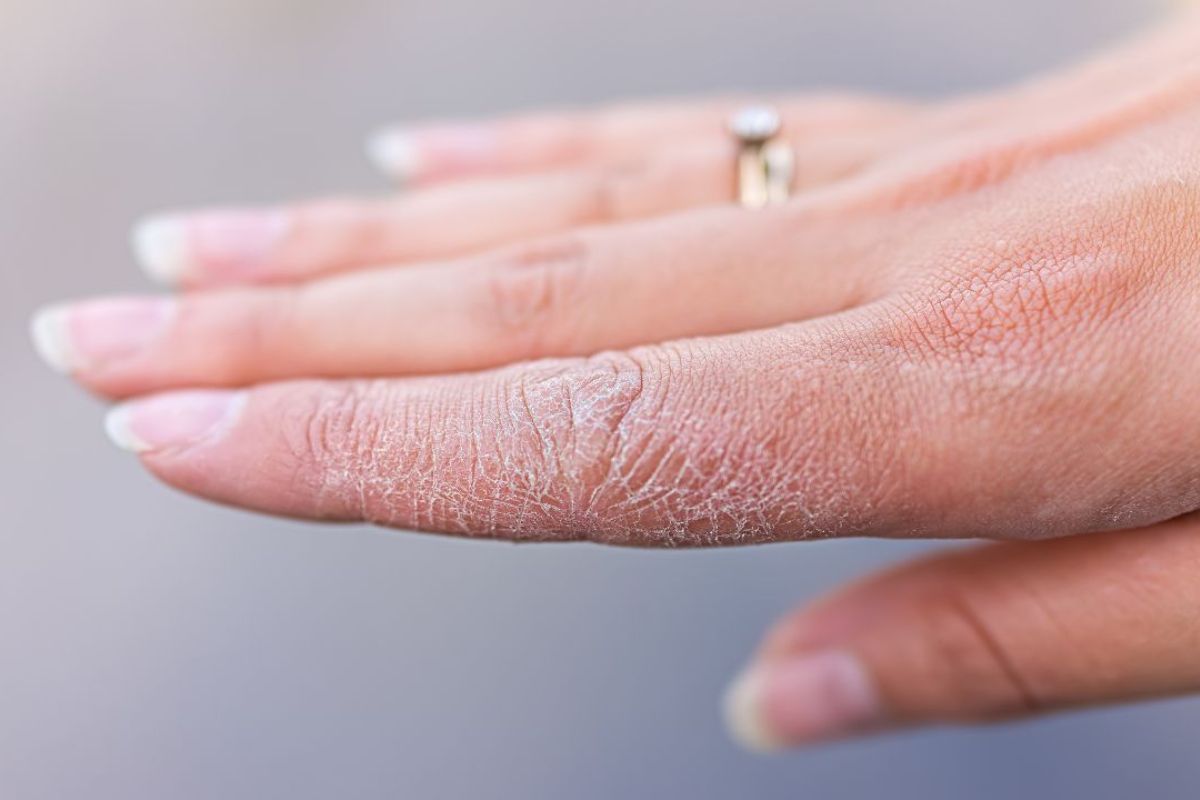 4 componentes essenciais para prevenir e tratar mãos ressecadas