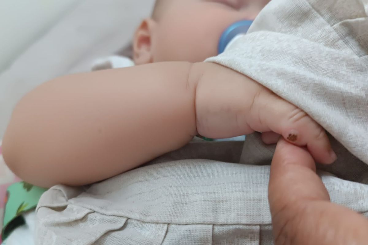 Bebê vai a hospital para operar dedo extra, mas médica erra cirurgia