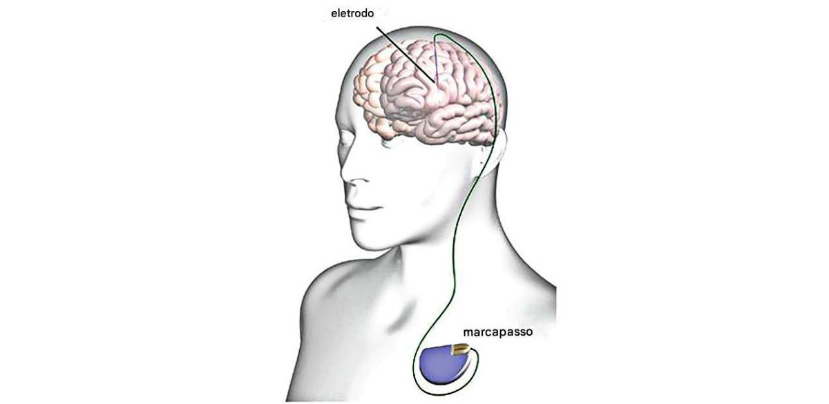 Implantes cerebrais melhoram 50% dos casos resistentes de depressão